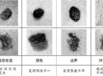 色素痣与黑色素瘤的鉴别要点解析